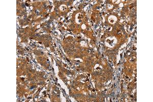 Immunohistochemistry of Human thyroid cancer using CEACAM3 Polyclonal Antibody at dilution of 1:30 (CEACAM3 anticorps)