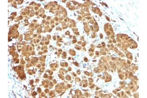 Formalin-fixed, paraffin-embedded human Melanoma stained with S100B Mouse Monoclonal Antibody (S100B/1012). (S100B anticorps)