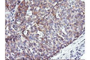 Immunohistochemical staining of paraffin-embedded Adenocarcinoma of Human ovary tissue using anti-NMT2 mouse monoclonal antibody. (NMT2 anticorps)