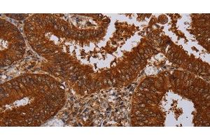 Immunohistochemistry of paraffin-embedded Human colon cancer tissue using MFAP3L Polyclonal Antibody at dilution 1:50 (MFAP3L anticorps)