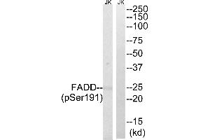 Immunohistochemistry analysis of paraffin-embedded human breast carcinoma tissue, using FADD (Phospho-Ser191) antibody. (FADD anticorps  (pSer191))