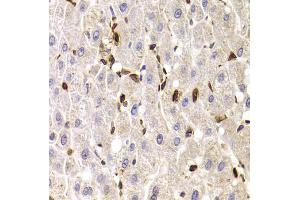 Immunohistochemistry of paraffin-embedded human liver injury using SPN antibody (ABIN5973813) at dilution of 1/100 (40x lens). (CD43 anticorps)