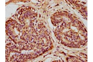 IHC image of ABIN7170979 diluted at 1:100 and staining in paraffin-embedded human breast cancer performed on a Leica BondTM system.