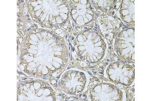 Immunohistochemistry of paraffin-embedded Human gastric cancer using PTP4A3 Polyclonal Antibody at dilution of 1:100 (40x lens).