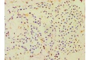 Immunohistochemistry of paraffin-embedded human breast cancer using ABIN7151000 at dilution of 1:100 (CBLC anticorps  (AA 245-474))