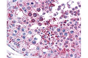 Immunohistochemistry (IHC) image for anti-Melanoma Antigen Family A, 3 (MAGEA3) (Middle Region) antibody (ABIN2782498) (MAGEA3 anticorps  (Middle Region))