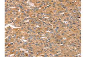 The image on the left is immunohistochemistry of paraffin-embedded Human liver cancer tissue using ABIN7128752(CAPN7 Antibody) at dilution 1/20, on the right is treated with fusion protein. (Calpain 7 anticorps)