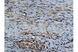 Formalin-fixed and paraffin embedded human colon carcinoma labeled with Rabbit Anti GM-CSF Polyclonal Antibody, Unconjugated (ABIN704156) at 1:200 followed by conjugation to the secondary antibody and DAB staining (GM-CSF anticorps  (AA 65-144))