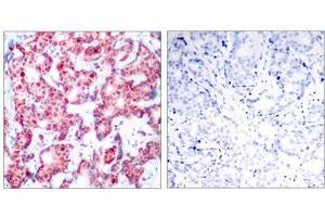 Immunohistochemical analysis of paraffin-embedded human breast carcinoma tissue using GATA1(Phospho-Ser142) Antibody(left) or the same antibody preincubated with blocking peptide(right). (GATA1 anticorps  (pSer142))