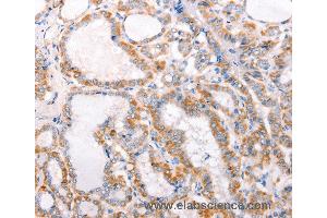 Immunohistochemistry of Human thyroid cancer using TRAF5 Polyclonal Antibody at dilution of 1:30 (TRAF5 anticorps)