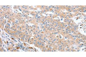 Immunohistochemistry of paraffin-embedded Human gastric cancer using WNT3A Polyclonal Antibody at dilution of 1:40 (WNT3A anticorps)