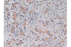 IHC-P analysis of Human Prostate Gland Cancer Tissue, with DAB staining. (Kallikrein 2 anticorps  (AA 19-261))