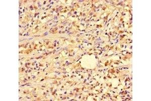 Immunohistochemistry of paraffin-embedded human gastric cancer using ABIN7144964 at dilution of 1:100 (PIF1 anticorps  (AA 125-360))