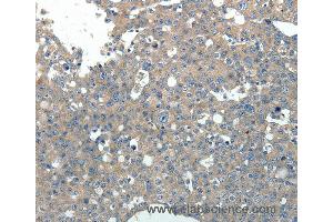 Immunohistochemistry of Human breast cancer using PVALB Polyclonal Antibody at dilution of 1:20 (PVALB anticorps)