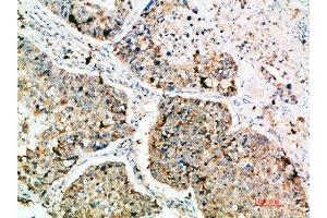 Immunohistochemical analysis of paraffin-embedded human-lung-cancer, antibody was diluted at 1:200 (LAMP3 anticorps  (AA 261-310))