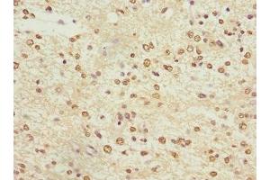 Immunohistochemistry of paraffin-embedded human glioma using ABIN7163952 at dilution of 1:100