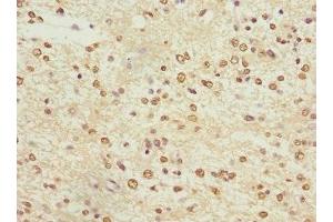 Immunohistochemistry of paraffin-embedded human glioma using ABIN7163952 at dilution of 1:100 (KCNA3 anticorps  (AA 486-575))