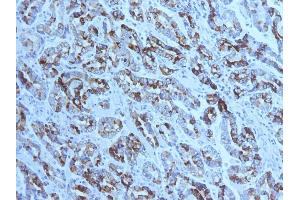 Formalin-fixed, paraffin-embedded human Gastric Carcinoma stained with MUC6 Mouse Monoclonal Antibody (CLH5). (MUC6 anticorps)