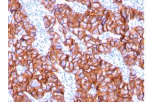 Formalin-fixed, paraffin-embedded human Breast Carcinoma stained with HER-2 Mouse Monoclonal Antibody (ERBB2/3078).