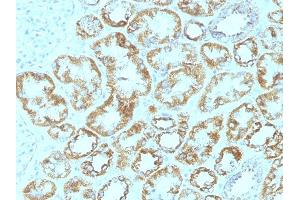 Formalin-fixed, paraffin-embedded human Renal Cell Carcinoma stained with Laminin Monoclonal Antibody (SPM193). (Laminin gamma 1 anticorps)