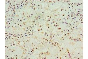 Immunohistochemistry of paraffin-embedded human breast cancer using ABIN7144000 at dilution of 1:100 (Aminoacylase 1 anticorps  (AA 1-408))