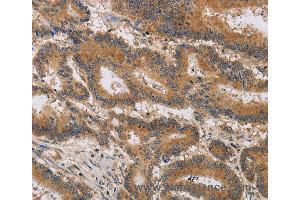 Immunohistochemistry of Human thyroid cancer using ITIH1 Polyclonal Antibody at dilution of 1:30 (ITIH1 anticorps)