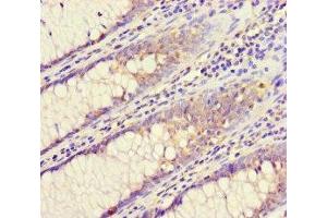 Immunohistochemistry of paraffin-embedded human colon cancer using ABIN7147525 at dilution of 1:100 (CHMP4C anticorps  (AA 1-233))