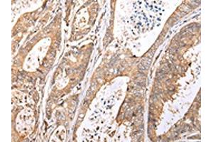 The image on the left is immunohistochemistry of paraffin-embedded Human colorectal cancer tissue using ABIN7193077(XKR7 Antibody) at dilution 1/20, on the right is treated with synthetic peptide. (XKR7 anticorps)