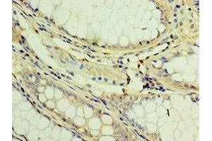 Immunohistochemistry of paraffin-embedded human colon cancer using ABIN7173394 at dilution of 1:100