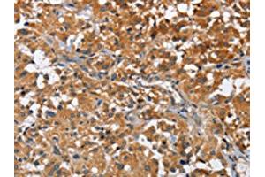 The image on the left is immunohistochemistry of paraffin-embedded Human thyroid cancer tissue using ABIN7128585(ATP1B2 Antibody) at dilution 1/30, on the right is treated with fusion protein. (ATP1B2 anticorps)
