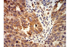 Immunohistochemical analysis of paraffin-embedded ovarian cancer tissues using ACVR1 mouse mAb with DAB staining.