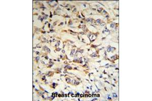 CPN2 Antibody (RB18703) IHC analysis in formalin fixed and paraffin embedded human breast carcinoma tissue followed by peroxidase conjugation of the secondary antibody and DAB staining. (CPN2 anticorps  (N-Term))