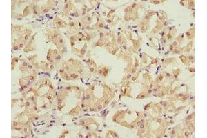 Immunohistochemistry of paraffin-embedded human gastric cancer using ABIN7142206 at dilution of 1:100 (PSMD12 anticorps  (Regulatory Subunit 12))