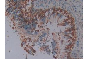 DAB staining on IHC-P; Samples: Human Lung cancer Tissue (SERPINB3 anticorps  (AA 1-210))