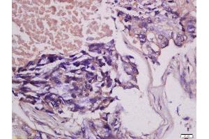Formalin-fixed and paraffin embedded human lung carcinoma tissue labeled with Anti-MCSF Polyclonal Antibody, Unconjugated 1:400 followed by conjugation to the secondary antibody and DAB staining.