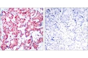 Immunohistochemistry analysis of paraffin-embedded human breast carcinoma, using GATA1 (Phospho-Ser142) Antibody. (GATA1 anticorps  (pSer142))