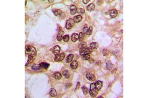 Immunohistochemical analysis of NF-kappaB p105/p50 (pS337) staining in human prostate cancer formalin fixed paraffin embedded tissue section.
