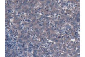 IHC-P analysis of Human Endometrial cancer Tissue, with DAB staining. (CD131 anticorps  (AA 133-233))