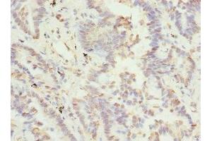 Immunohistochemistry of paraffin-embedded human lung cancer using ABIN7171838 at dilution of 1:100