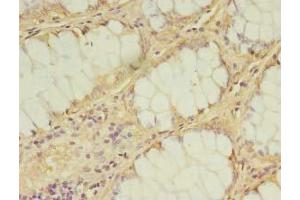 Immunohistochemistry of paraffin-embedded human breast cancer using ABIN7157126 at dilution of 1:100 (IPP Isomerase 2 anticorps  (AA 1-227))