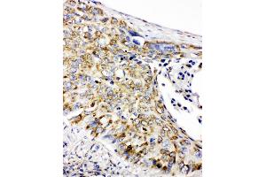 Anti-Prohibitin antibody, IHC(P) IHC(P): Human Lung Cancer Tissue