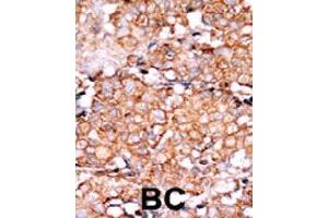 Formalin-fixed and paraffin-embedded human cancer tissue reacted with RAD9A (phospho S328) polyclonal antibody  which was peroxidase-conjugated to the secondary antibody followed by AEC staining. (RAD9A anticorps  (pSer328))