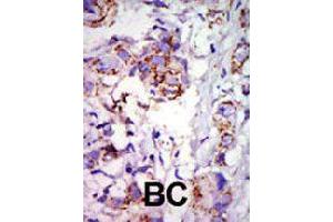 Formalin-fixed and paraffin-embedded human cancer tissue reacted with GRK6 polyclonal antibody  , which was peroxidase-conjugated to the secondary antibody, followed by DAB staining .