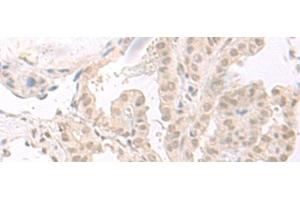 Immunohistochemistry of paraffin-embedded Human thyroid cancer tissue using HOOK2 Polyclonal Antibody at dilution of 1:30(x200)
