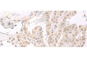 Immunohistochemistry of paraffin-embedded Human thyroid cancer tissue using HOOK2 Polyclonal Antibody at dilution of 1:30(x200) (HOOK2 anticorps)