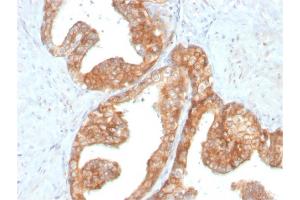 Formalin-fixed, paraffin-embedded human Prostate Carcinoma stained with RET Mouse Monoclonal Antibody (RET/2795).