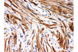 Anti- IKB beta Picoband antibody,IHC(P) IHC(P): Human Intestinal Cancer Tissue (NFKBIB anticorps  (AA 56-237))