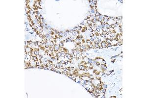 Immunohistochemistry of paraffin-embedded human liver cancer using S Rabbit pAb (ABIN1682619, ABIN3017779, ABIN3017780 and ABIN6220246) at dilution of 1:200 (40x lens).