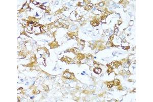 Immunohistochemistry of paraffin-embedded Human liver cancer using SERPINA3 Polyclonal Antibody at dilution of 1:100 (40x lens). (SERPINA3 anticorps)