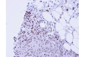 IHC-P Image Immunohistochemical analysis of paraffin-embedded Cal27 Xenograft, using SSRP1, antibody at 1:100 dilution.